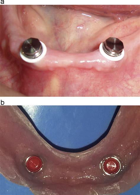 what is the metal housing of the denture|metal dentures problems.